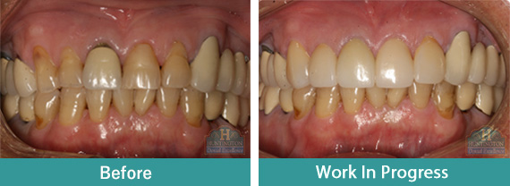 Smile Gallery - Before After Image-1 , Huntington Dental Excellence, South Pasadena