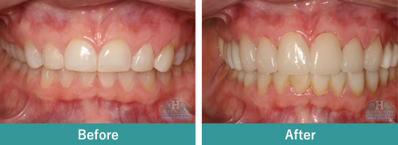 Smile Gallery - Before After Image-2 , Huntington Dental Excellence, South Pasadena