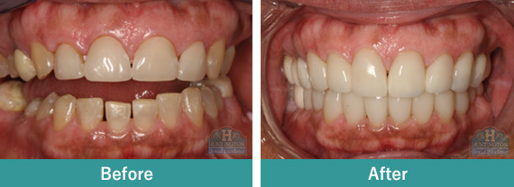 Smile Gallery - Before After Image-3 , Huntington Dental Excellence, South Pasadena