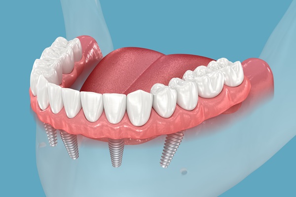 How Many Implants Are Needed For Lower Implant Supported Dentures?